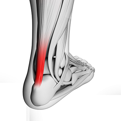 Tendinopathy tendonitis achilles patella