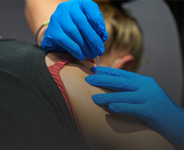 Dry Needling Manual Therapy